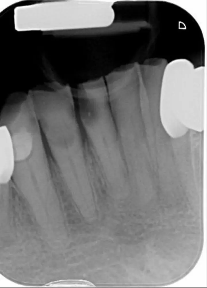 Radiografie cu canale calcifiate la dinții frontali inferiori