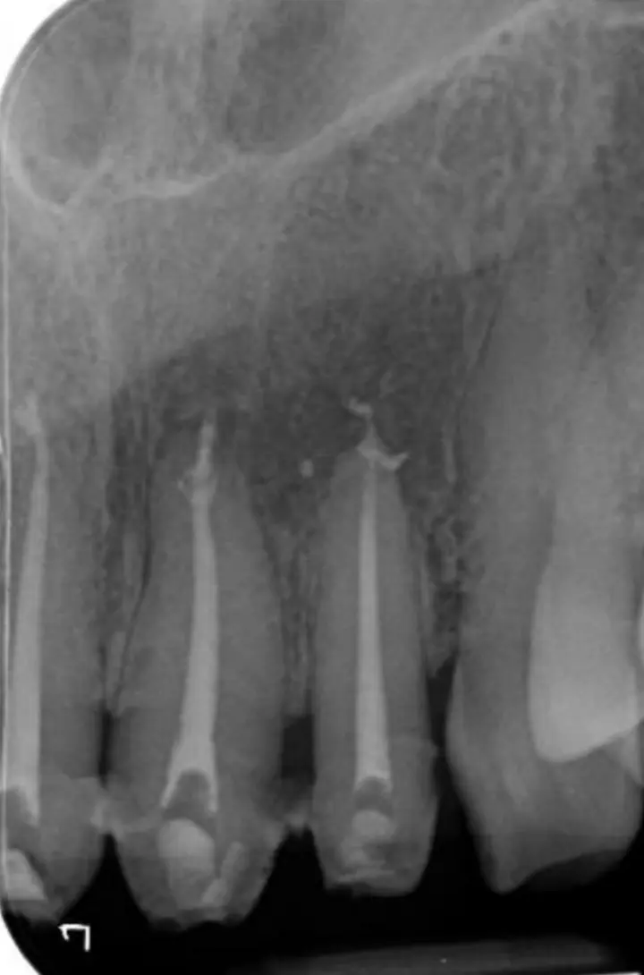 Radiografie la 6 luni după retratament