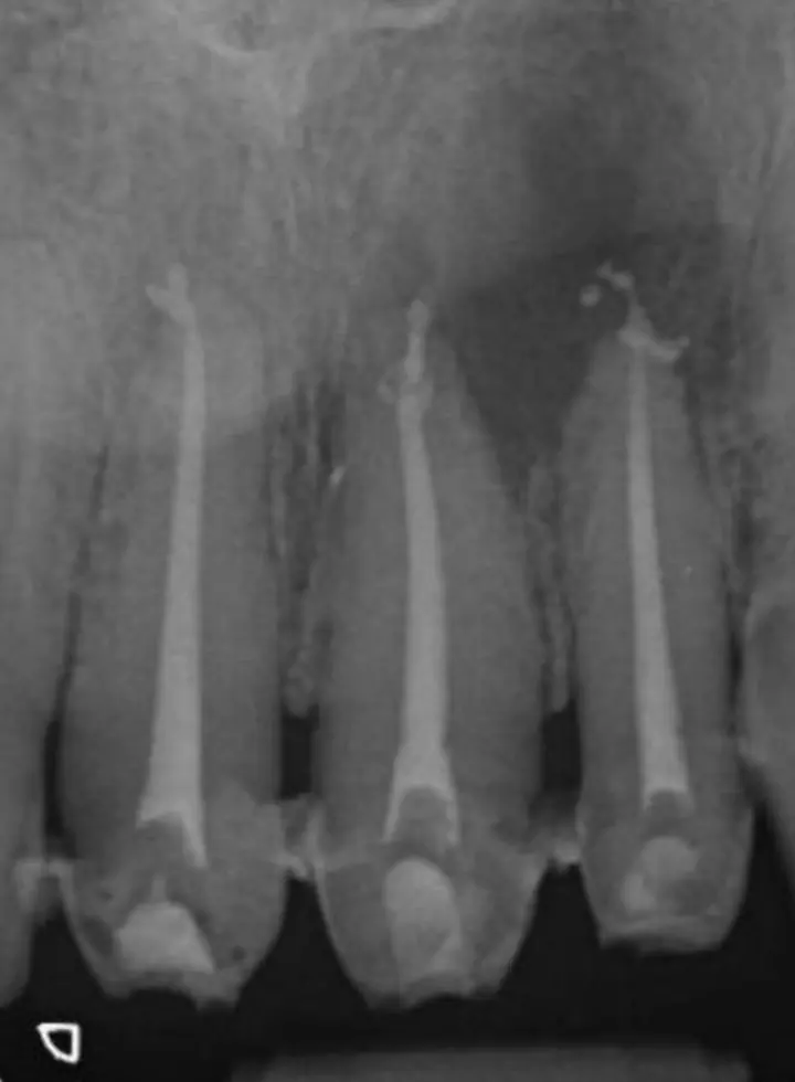 Radiografie imediat după retratament
