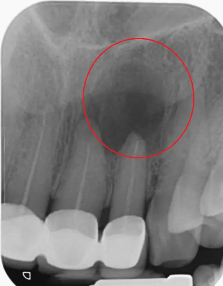 Radiografie cu infecție la vârful rădăcinilor a doi incisivi