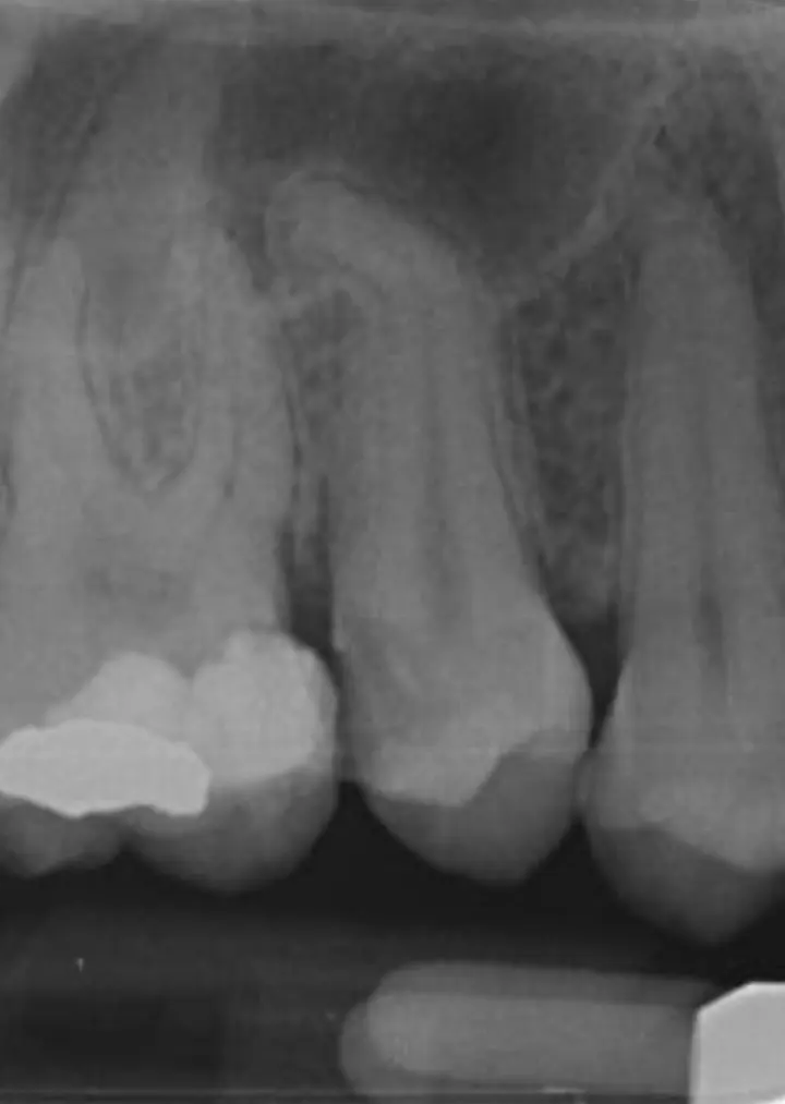 Premolar cu rădăcina curbată la aproape 90 de grade