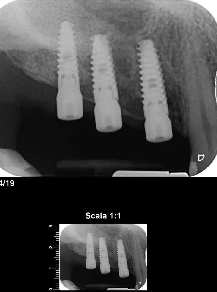 Radiografie cu cele trei implanturi după sinus lift
