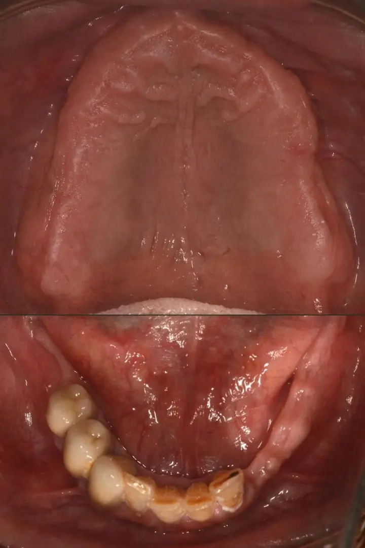 Mandibula după extracții