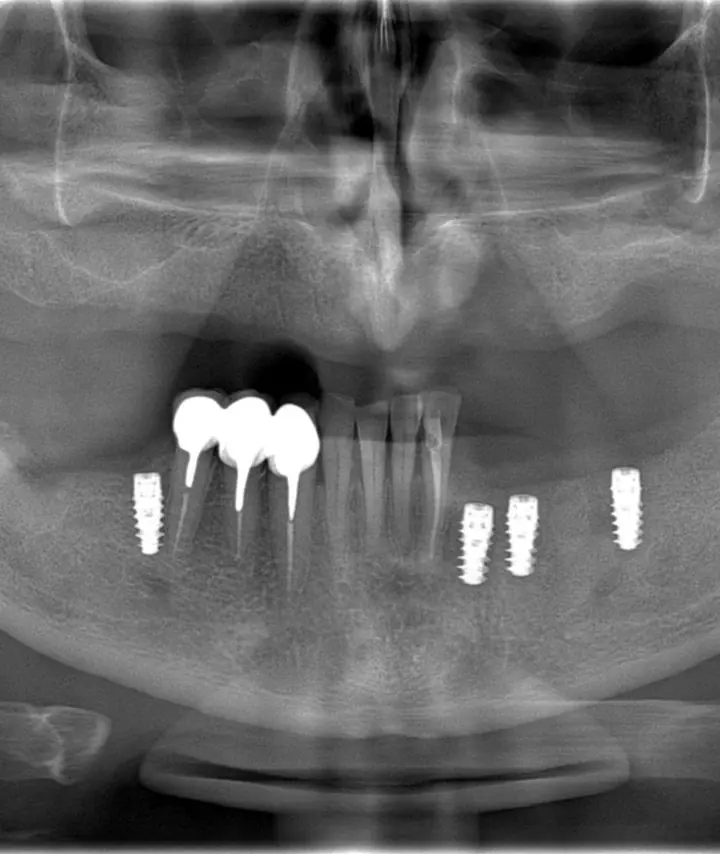 Radiografie cu cele 4 implanturi mandibulare