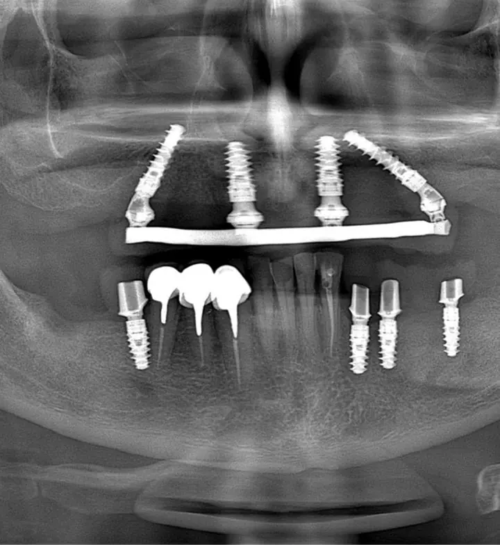 Radiografie cu lucrarea All-on-4 la maxilar