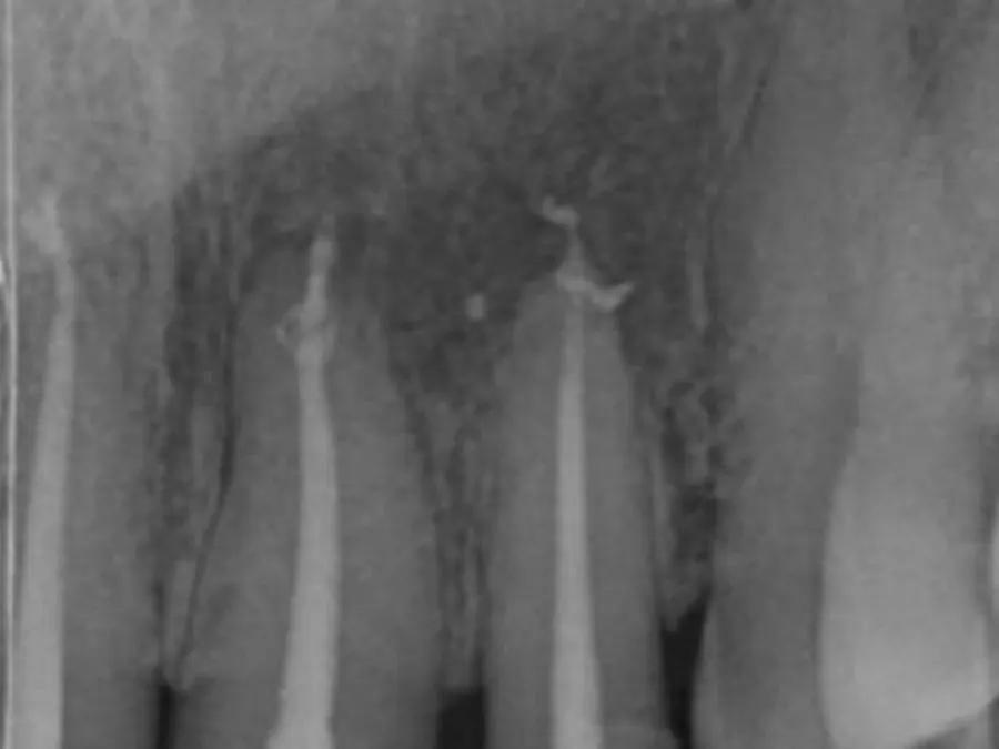 Radiografie la 6 luni după retratamentul de canal al incisivilor superiori
