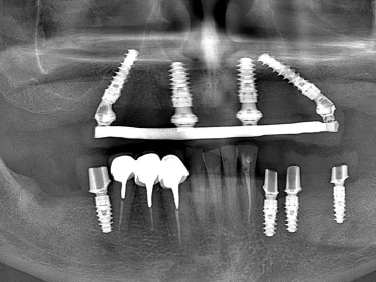 Radiografie panoramică cu patru implanturi la maxilar și implanturi la mandibulă, pacient Eurosmile
